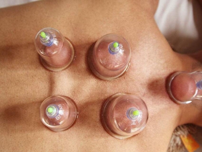 拔火罐减肥一定要注意这些事