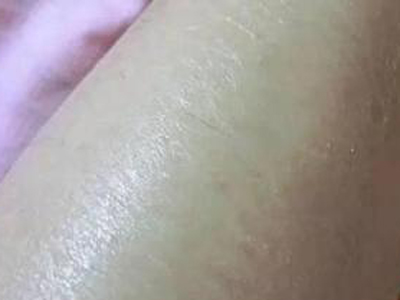 皮肤长了橘皮纹赶紧试试这方法