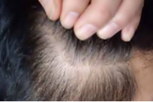 少年白怎么改善发质 头发变黑的方法有哪些