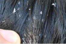 有头屑怎么办 如何快速去头屑？