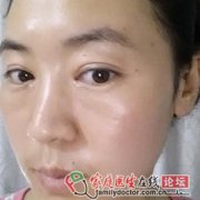 做了激光祛斑 过来晒晒照片？