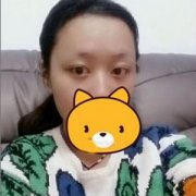 自体脂肪丰苹果肌 效果还算行吧