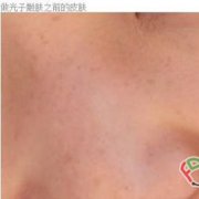 做了光子嫩肤会来了 靓照仅供参考？