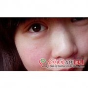 做了E光美容，脸上红血丝不见了？