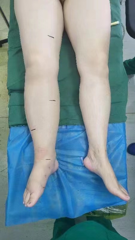 两条腿突然变成一个粗一个细，不能从事体力劳动，全国各地到处寻医没有良好的治疗方案